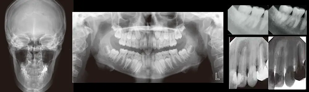 歯科用CT・デジタルレントゲン