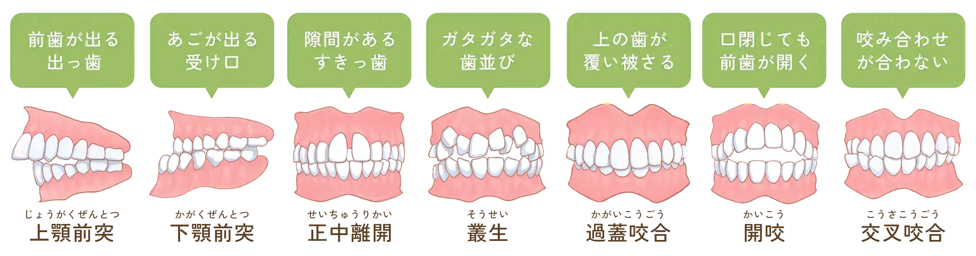不正歯列
