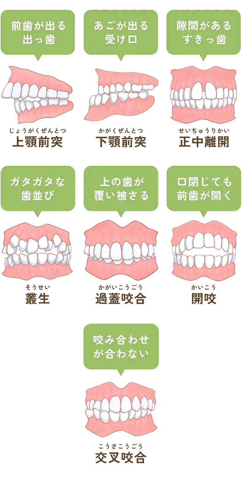 不正歯列