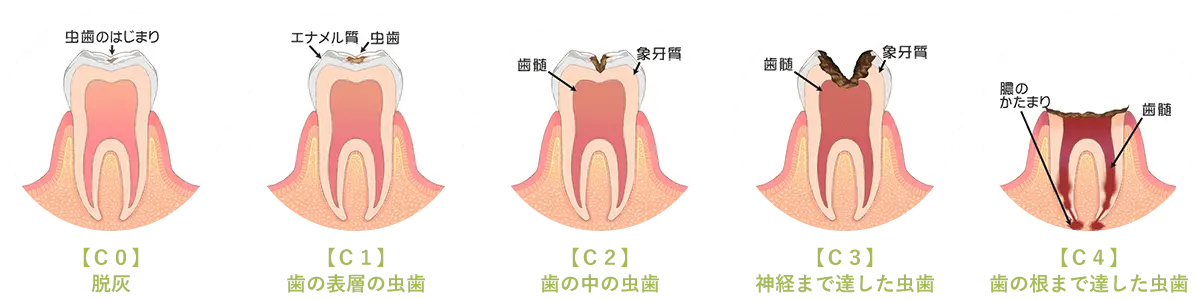 虫歯の進行