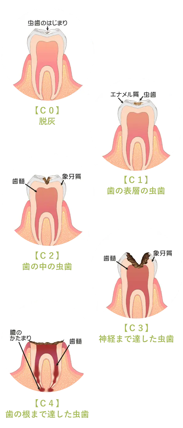 虫歯の進行